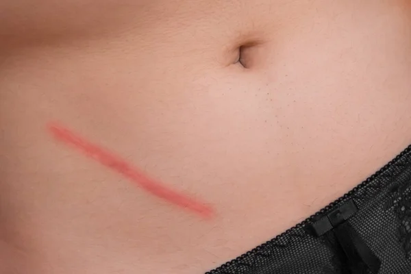 手術の虫垂炎手術の結果を除去した後 体腹部の皮膚の傷 クローズアップ — ストック写真