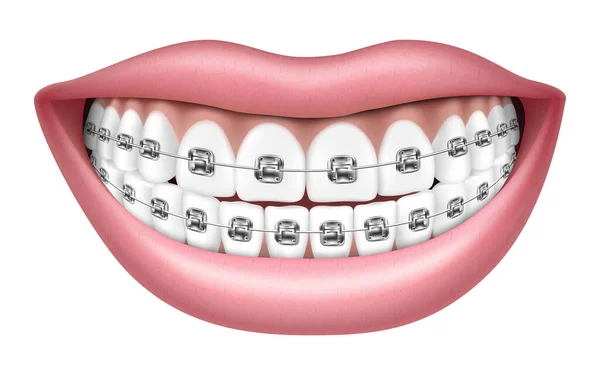 Lächeln Sie Mit Weißen Zähnen Und Zahnspangen Realistische Vektordarstellung Isoliert — Stockfoto