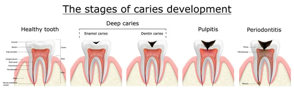 Stages Caries Development Dental Disease Caries Pulpitis Periodontitis Realistic Vector — ストック写真