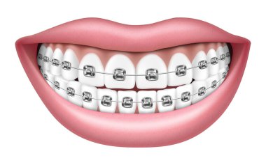 Smile with white teeth and braces. Realistic 3D Vector illustration, isolated on white background