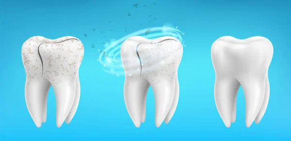 Realistische Saubere Und Schmutzige Zähne Auf Blauem Hintergrund Zahnreinigungs Und — Stockvektor