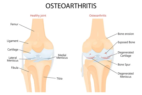 Knee Osteoarthritis Normal Joint Detailed Anatomy Osteoarthritis Arthritis Pain Joint — Vettoriale Stock