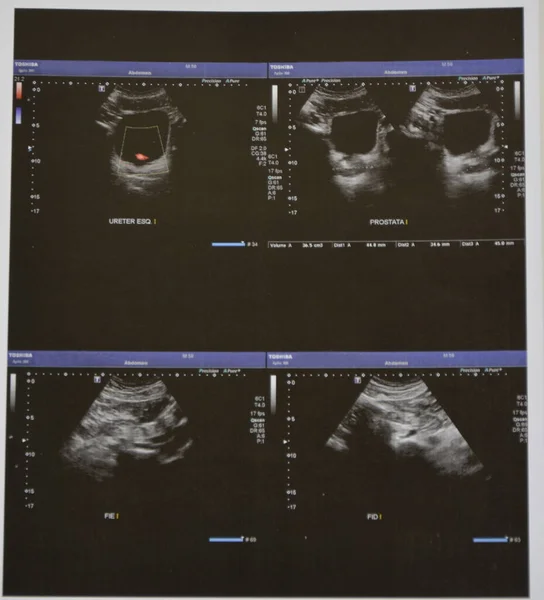 Ultrasonografie Van Bovenbuik Met Gevisualiseerde Delen Van Ureter Prostaat — Stockfoto
