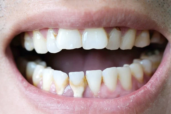 Tooth Seorang Pria Merokok Buruk Orang Merokok Memiliki Kerusakan Gigi — Stok Foto