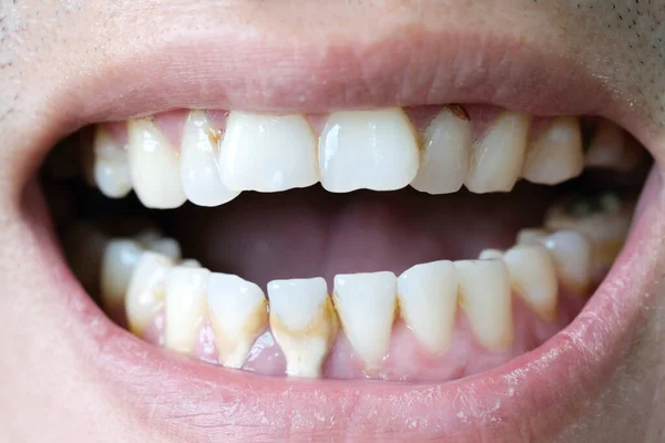 Tooth Man Smoking Bad Man Smokes Cigarettes Have Tooth Decay — Stock Photo, Image