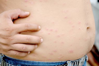 Adamın ellerini sırtını kaşımak için kullanıyor. Deri iltihabı ve kaşıntı hissi yüzünden..