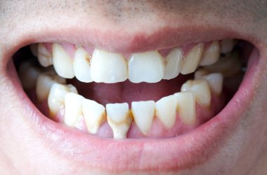 Diş kötü sigara içen bir adam. Sigara içen bir adamın diş çürüğü ve diş kalkülüsü vardır, bu yüzden hijyene dikkat etmeliyiz..