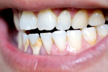 Diş kötü sigara içen bir adam. Sigara içen bir adamın diş çürüğü ve diş kalkülüsü vardır, bu yüzden hijyene dikkat etmeliyiz..