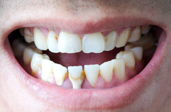 Зуб человек, курящий плохо. Человек курит сигареты имеют кариес и расчет зубов, так что мы должны быть стоматологом с гигиеной.