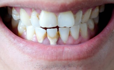 Diş kötü sigara içen bir adam. Sigara içen bir adamın diş çürüğü ve diş kalkülüsü vardır, bu yüzden hijyene dikkat etmeliyiz..