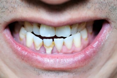 Diş kötü sigara içen bir adam. Sigara içen bir adamın diş çürüğü ve diş kalkülüsü vardır, bu yüzden hijyene dikkat etmeliyiz..