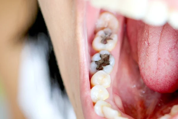 Tooth Man Smoking Bad Man Smokes Cigarettes Have Tooth Decay — Stock Photo, Image