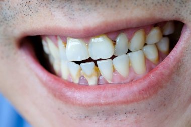 Diş kötü sigara içen bir adam. Sigara içen bir adamın diş çürüğü ve diş kalkülüsü vardır, bu yüzden hijyene dikkat etmeliyiz..