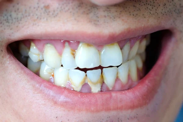 Tooth Man Smoking Bad Man Smokes Cigarettes Have Tooth Decay — Stock Photo, Image