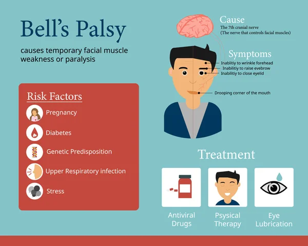 Bells Palsy Infographic Show Cause Symptom — Stock Vector