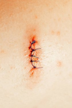 Stitched wound and medical suture, close-up. Medical sutures after operations, sewn surgical sutures on the human body. Medical and surgical care clipart