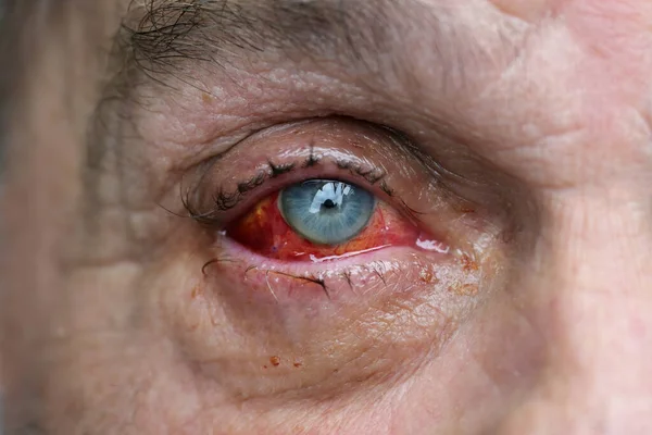 Eye of a man with injured conjunctiva due to an accident, sutured with several stitches and blood shot after surgery, health and medical theme, selected focus, narrow depth of field