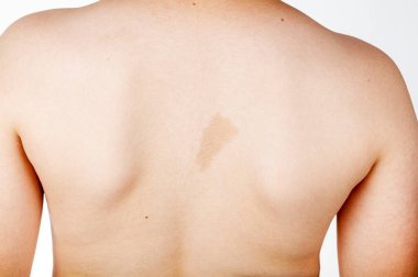 A large light brown cafe au lait spot known as birth mark on the inter scapular region of a caucasian male. This benign skin discoloration may be related to a genetical disorder neurofibromatosis. clipart