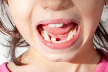 Küçük bir kızın ağzını gösterdiği ortodontik tedavi konsepti. Alt çene kalabalığı nedeniyle yanlış hizalanan dişler onu ortodontik tedavi için birinci aşama için birincil aday yapar.