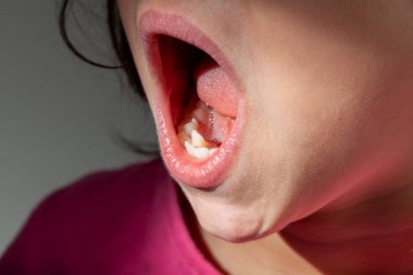 Küçük bir kızın ağzını gösterdiği ortodontik tedavi konsepti. Alt çene kalabalığı nedeniyle yanlış hizalanan dişler onu ortodontik tedavi için birinci aşama için birincil aday yapar.