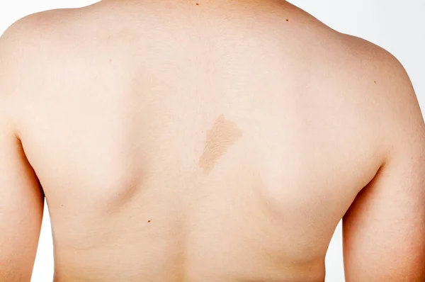 Large Light Brown Cafe Lait Spot Known Birth Mark Inter — Stock Photo, Image