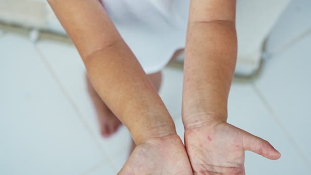 Энтеровирус Нога Рука Рот Сыпь Теле Ребенка Вирус Петуха Высококачественные — стоковое видео