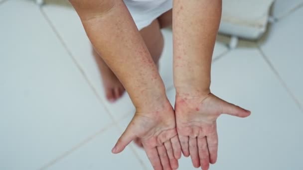 Enterovirus Leg Lengan Mulut Rash Pada Tubuh Seorang Anak Virus — Stok Video