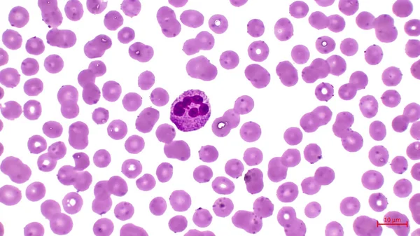 血が臭い ヒトの血液細胞を示す光マイクログラフ 赤血球はピンクです 彼らは血液細胞の大半を構成しています 核を持つ大きな細胞を見ることができます 好中球 — ストック写真