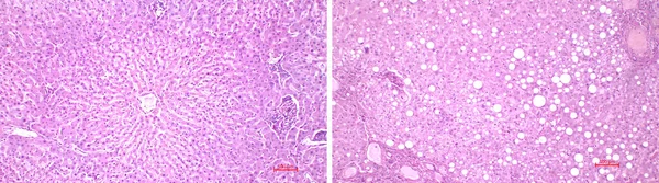 肝臓の光顕微鏡 健康なヒト肝臓 と脂肪性疾患 の影響を受けた肝臓の構造 組織学 の比較 ヘマトキシリンとエオシンの汚れ — ストック写真