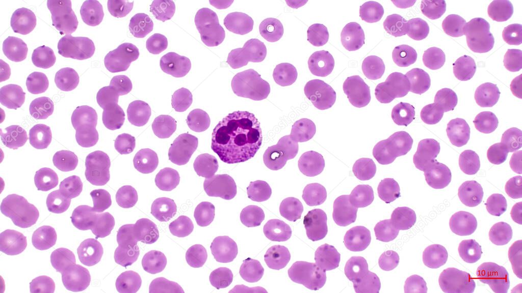 Blood smear. Light micrograph showing human blood cells. Erythrocytes are pink. They make up the majority of blood cells.  Also in the center you can see a large cell with a nucleus (neutrophil). 