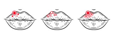 Herpes virus rash on lips, labial sore, inflammation skin face, stomatitis on woman mouth outline icon set. Blister, ulcer, red acne. Irritation, facial allergy reaction. Oral infection disease. Dermatology skincare problem. Medical treatment. Vector