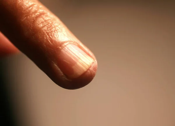 Infección fúngica bajo la uña. Un dedo en una mano con una infección fúngica de la uña. — Foto de Stock