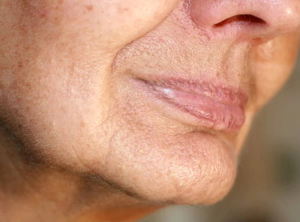 Flabbiness van de huid van de wangen. Rimpels in het gezicht. Nasolabiale rimpels. — Stockfoto
