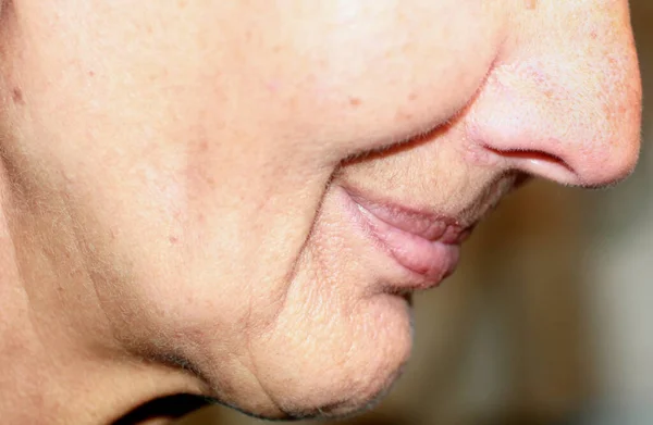 Flabbiness of the skin of the cheeks. Wrinkles on the face. Nasolabial wrinkles. — Stock Photo, Image