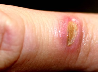 Deri yarası. Parmak derisinde yanık var..