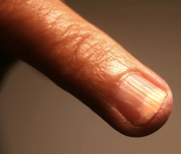 Fungal infection under the nail. A finger on a hand with a fungal infection of the nail.