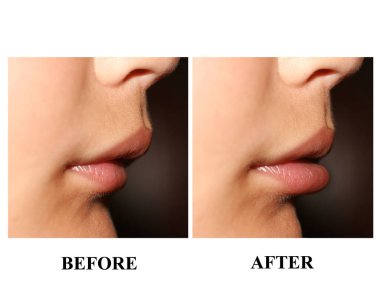 Bir çocukta yanlış ısırık. Çocuklarda maloklüzyon. Dudak profili.