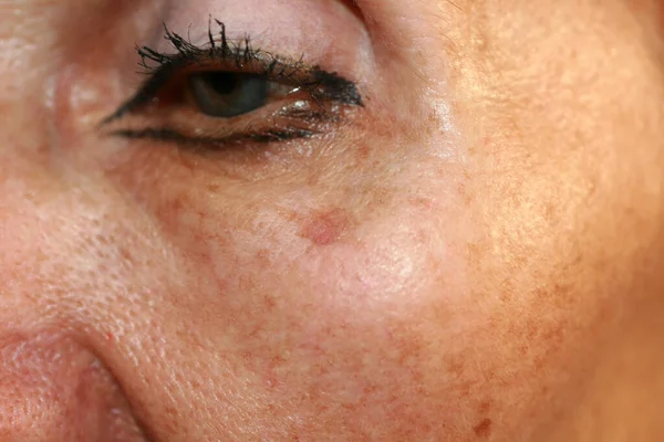 Пигментация кожи. Коричневые пятна пигментации на коже лица. — стоковое фото