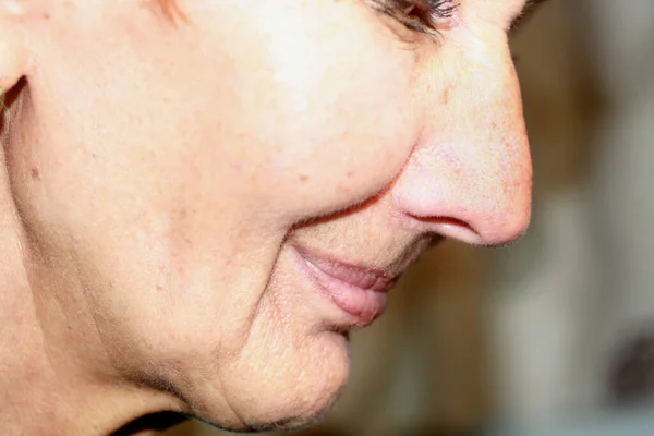 Flacidez de la piel de las mejillas. Arrugas en la cara. Arrugas nasolabiales. —  Fotos de Stock