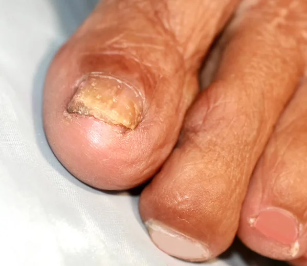 Грибковая инфекция под ногтем. Носок с грибковой инфекцией ногтя. — стоковое фото
