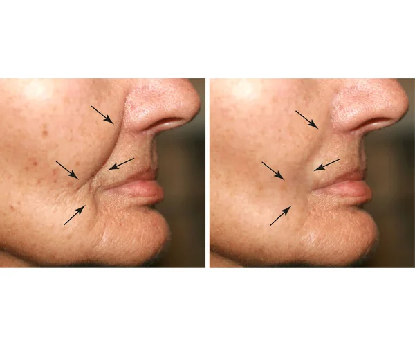 Rimpels in het gezicht. Dwaze huid op de wangen, Nasolabiale rimpel. Voor en na de behandeling. — Stockfoto