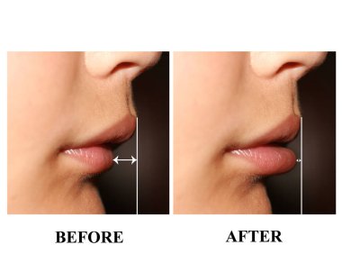 Bir çocukta yanlış ısırık. Çocuklarda maloklüzyon. Dudak profili.