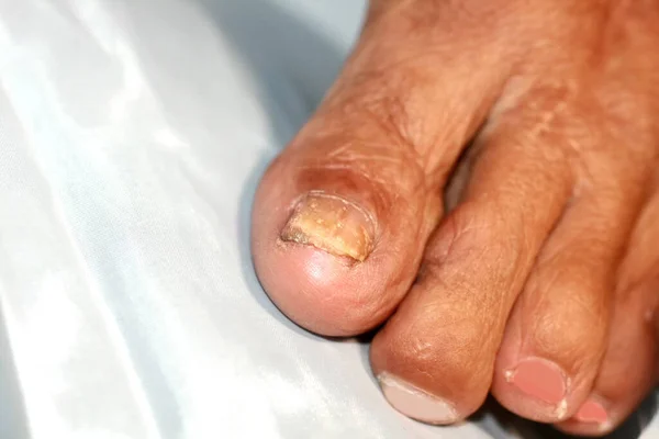 Pilzinfektion unter dem Nagel. Zehe mit Pilzinfektion des Nagels. — Stockfoto