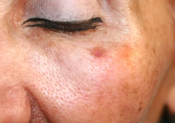 Skin pigmentation. Brown spots of pigmentation on the skin of the face.