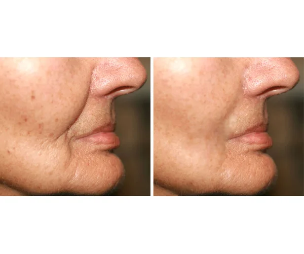 Морщины на лице. Плоская кожа на щеках, носогубная морщинка. До и после лечения. — стоковое фото