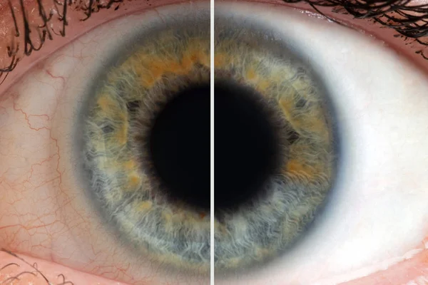 Human eye with blood vessels before and after — Stock Photo, Image