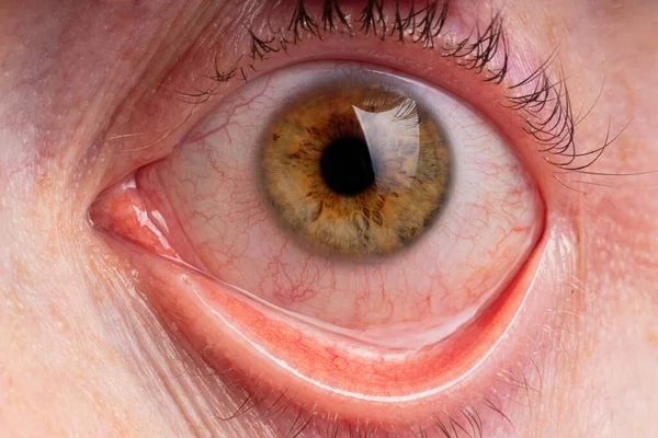 Müdes braunes Auge mit Blutgefäßen — Stockfoto