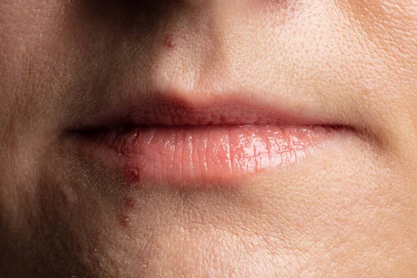 Человеческие губы закрываются прыщами на лице — стоковое фото