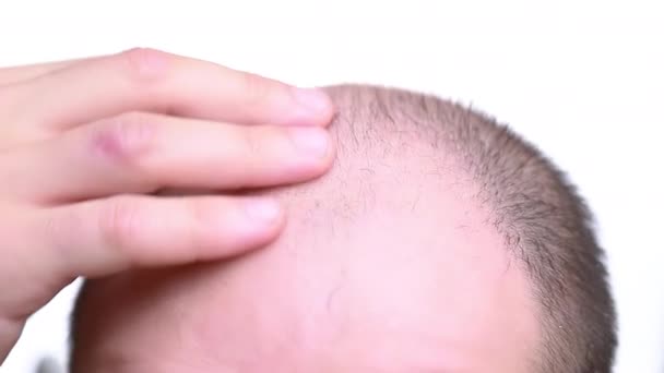Muž Podívá Kamery Své Holé Skvrny Problém Vypadávání Vlasů — Stock video