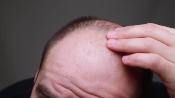 Hombre Mira Cámara Sus Puntos Calvos Problema Pérdida Cabello Concepto — Vídeo de stock